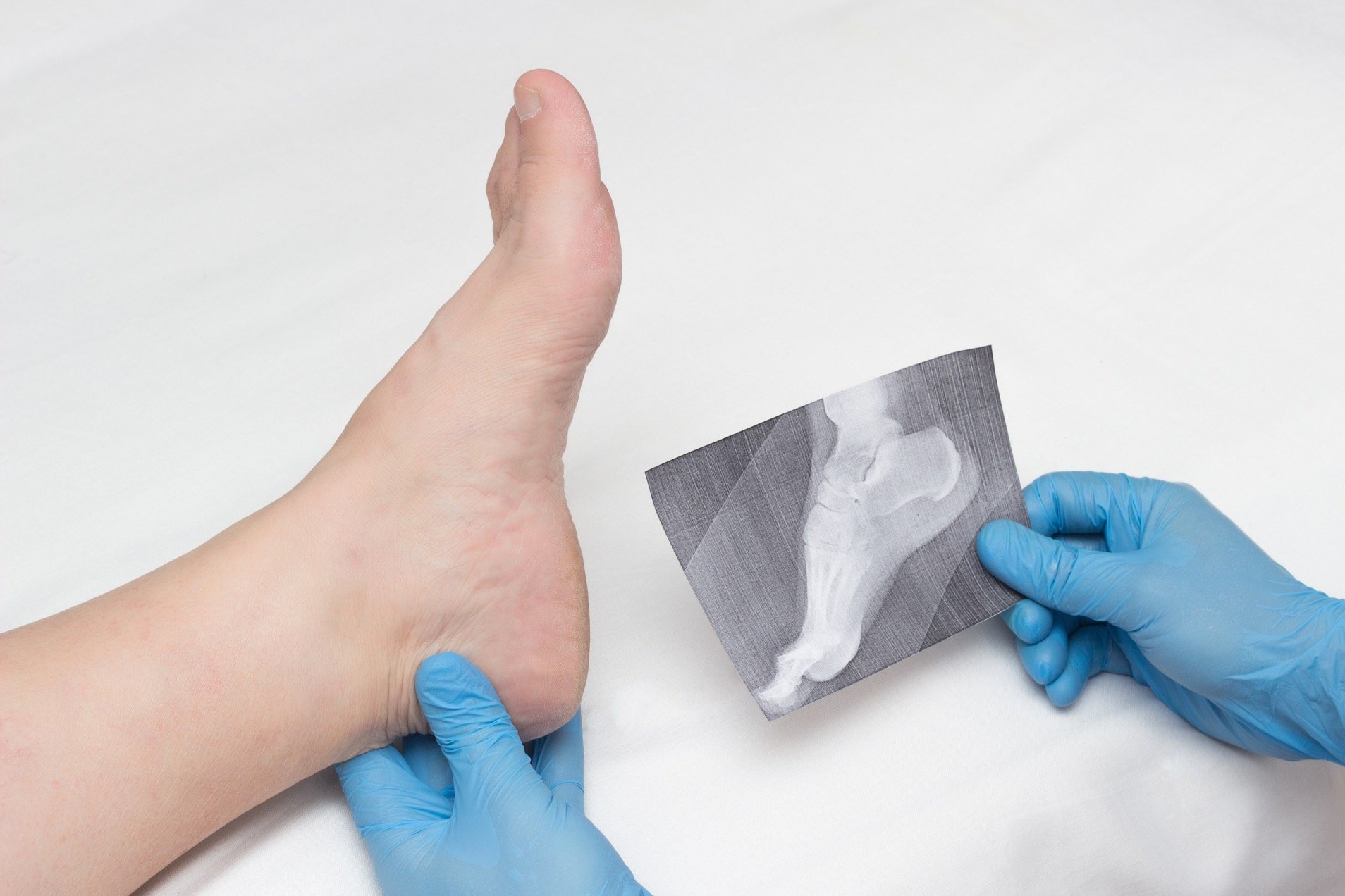 Doctor comparing patient's foot with an x-ray of bone spurs