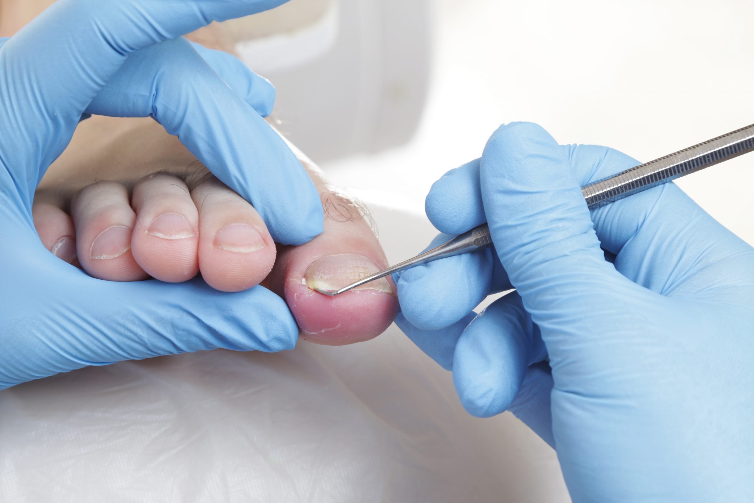 Doctor treating an ingrown toenail on male patient
