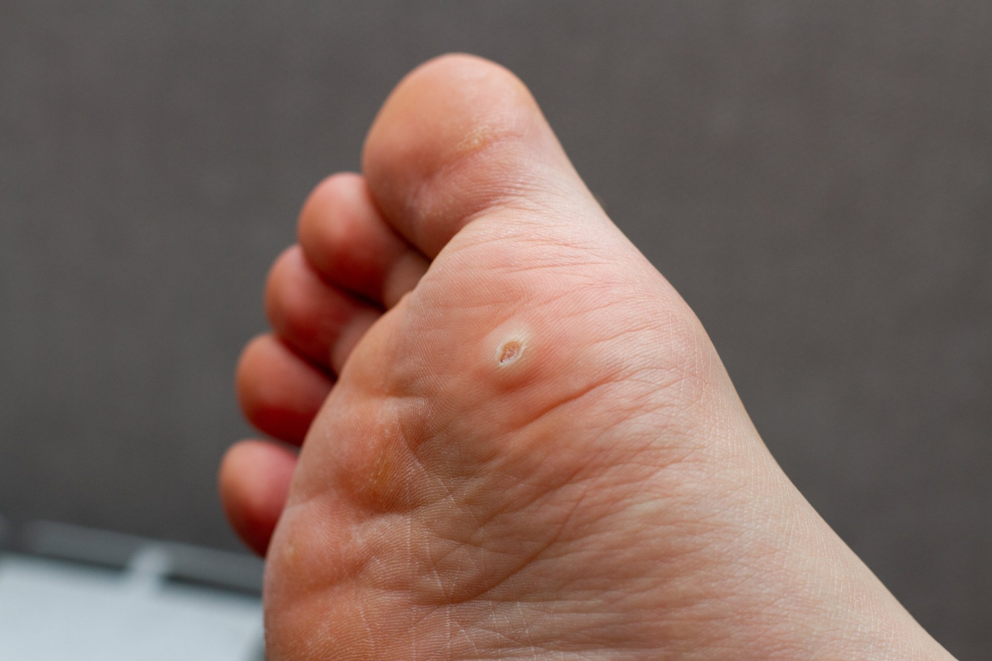 Young Boy with Plantar Wart on Foot