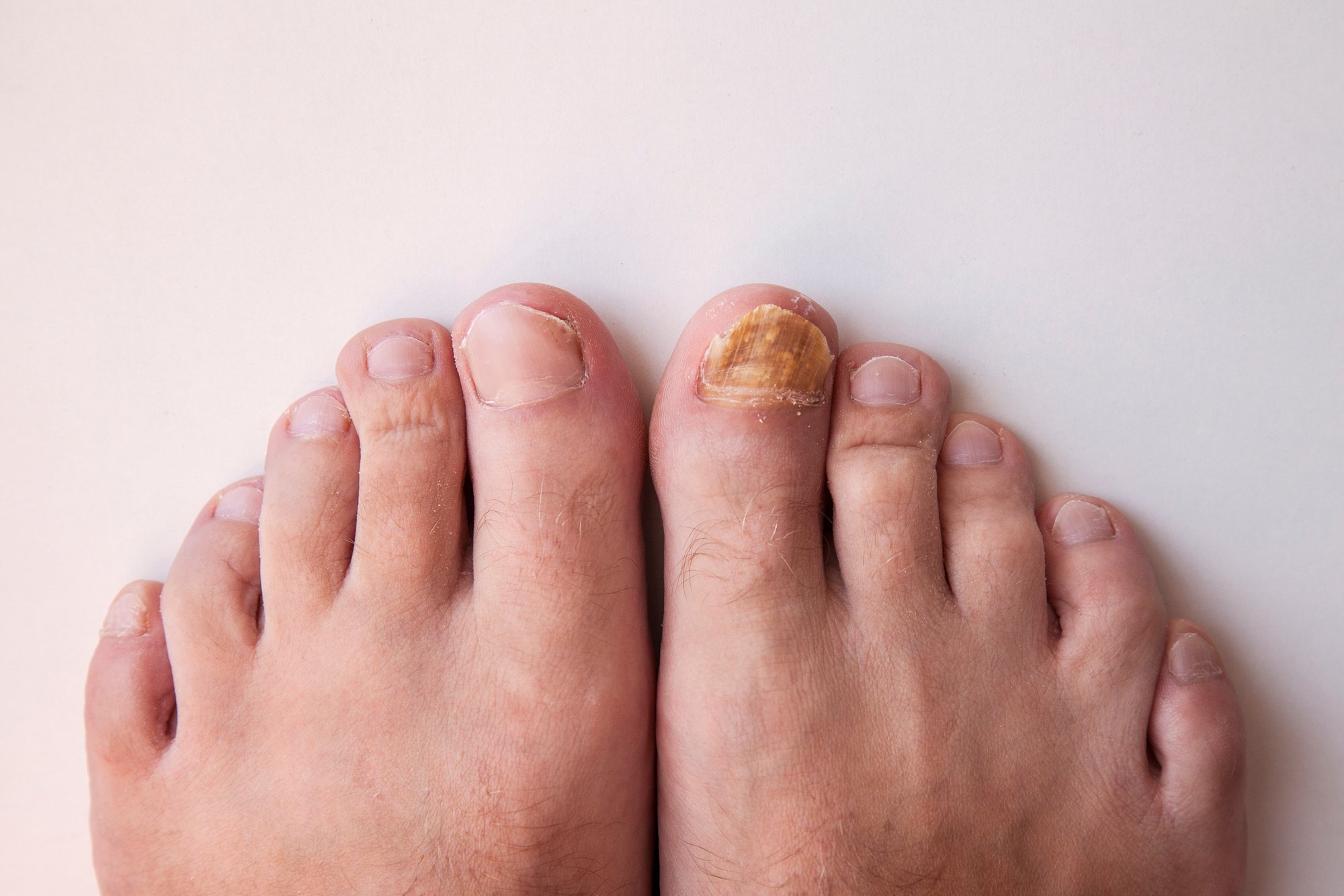 Feet with toenail fungus on the big right toe